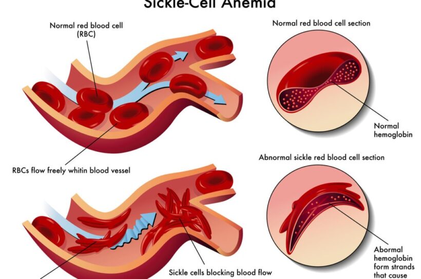 What are red blood cells and haemoglobin, and how do they cause anaemia in children?